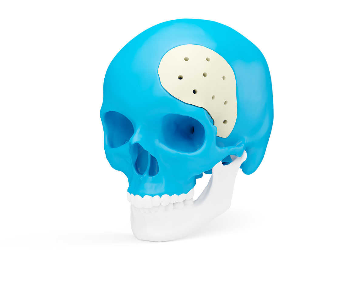 PEEK Cranial Implant (PCI)