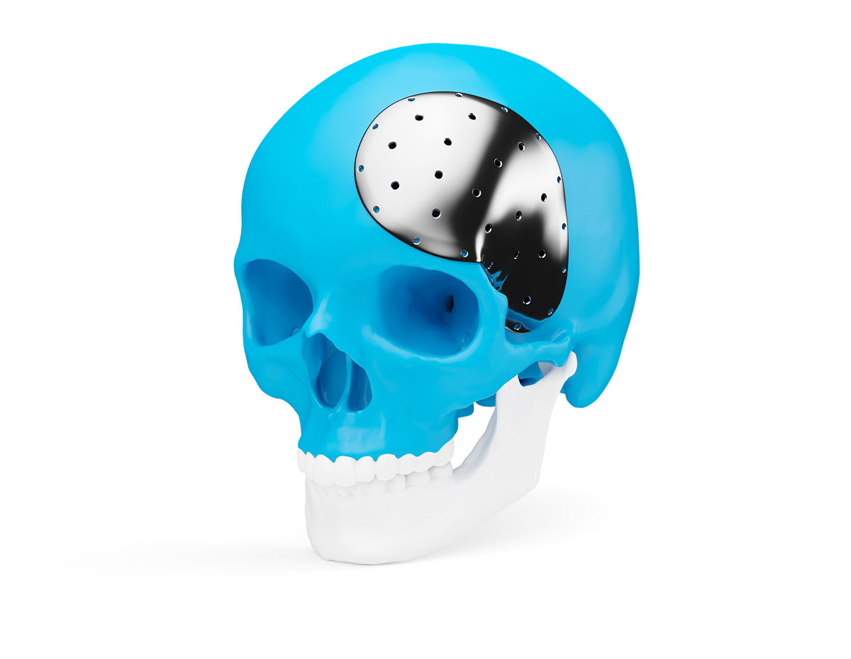 Titanium Cranial Implant (TCI)